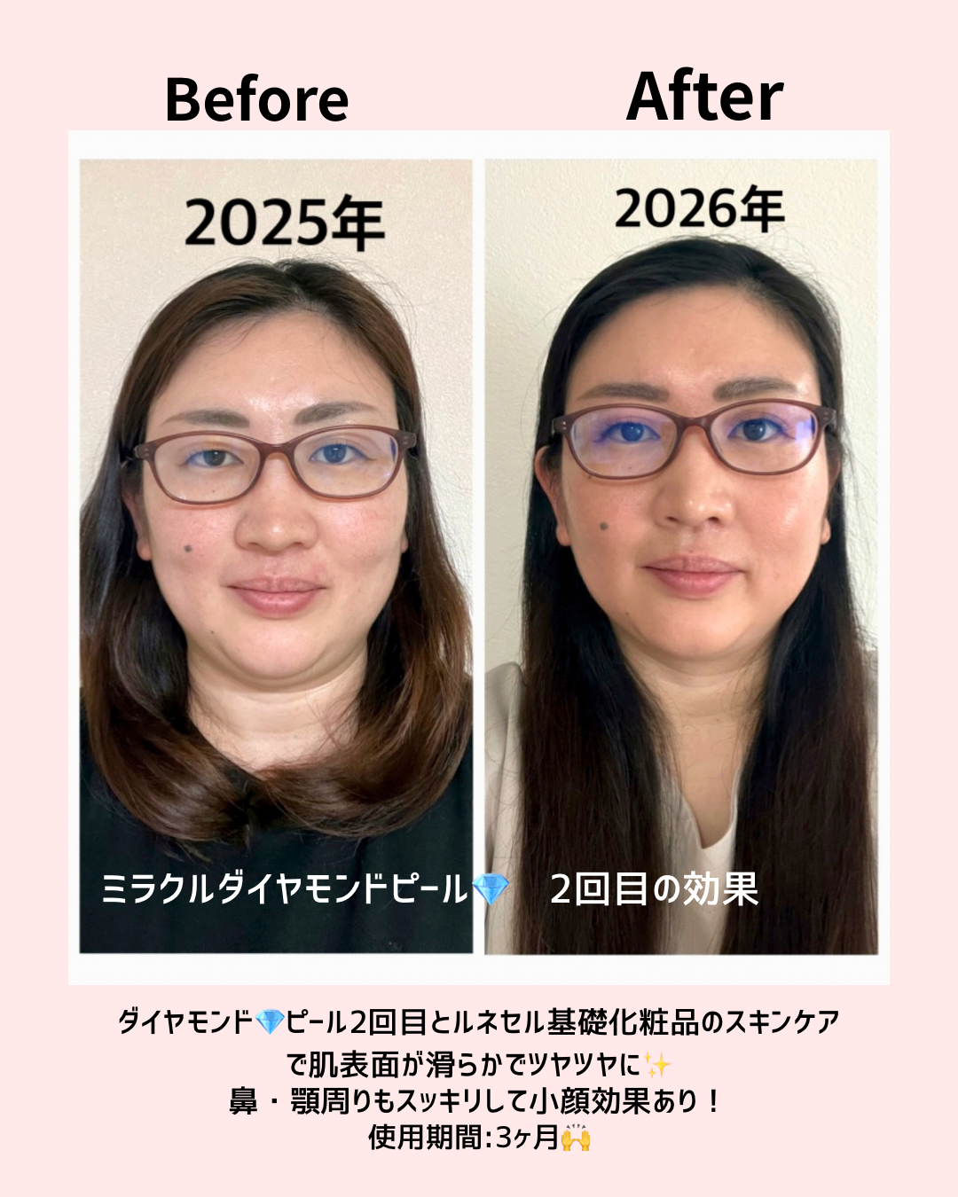 「1年前の肌と、今の肌。」